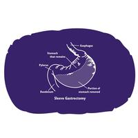 169 - Bariatric Pillow with Sleeve Gastrectomy Diagram - thumbnail